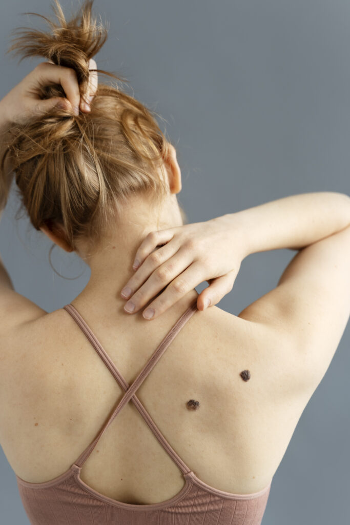 No 1 Warts Removal in Changanacherry and a complete solution